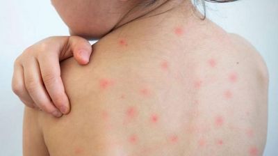 হাম উপসর্গ নিয়ে এক দিনে ১০ মৃত্যু