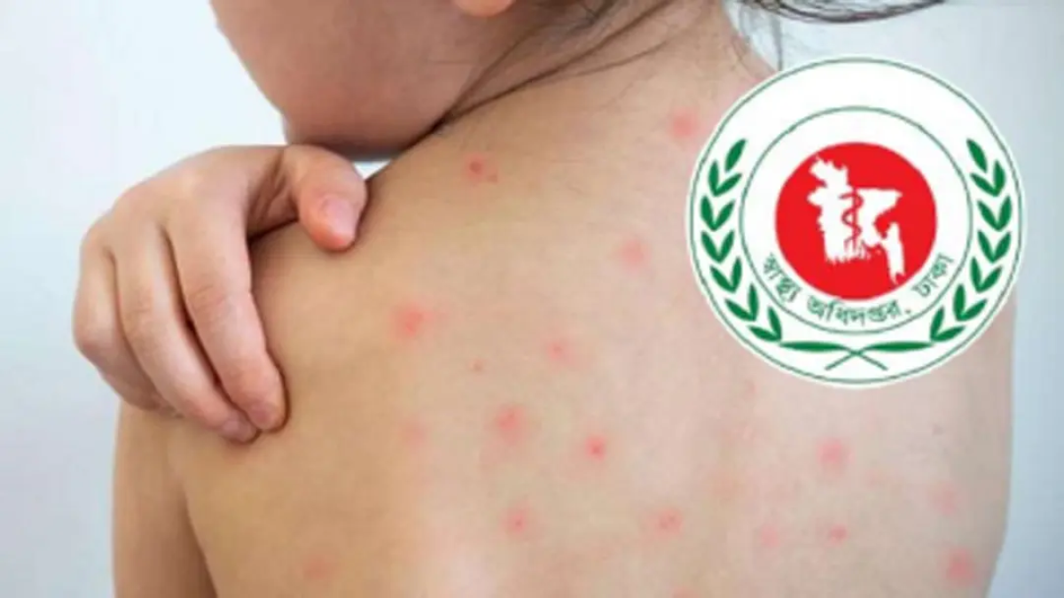 হাম ও হামের উপসর্গ নিয়ে সারা দেশে আরও ৫ শিশুর মৃত্যু